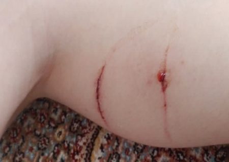 حمله سگ‌ هار به پسر ۱۲ ساله در مرکز شهر تبریز